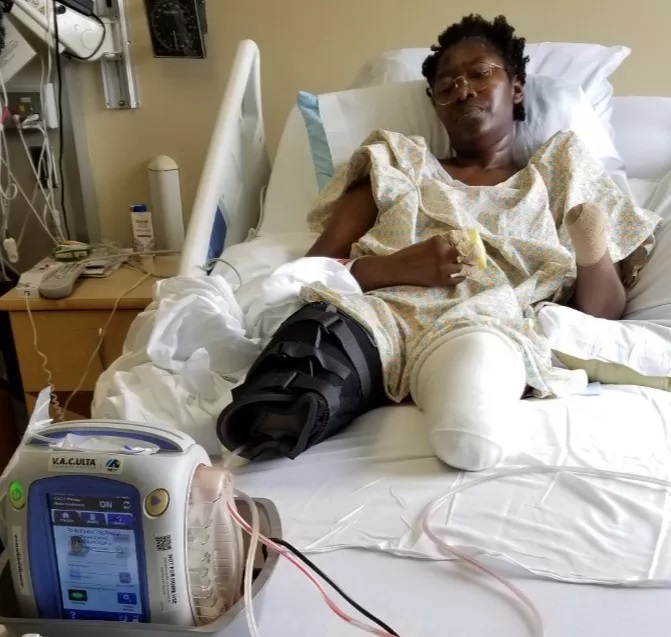 Jummai Nache lost both of her legs and left hand after her Covid Vax