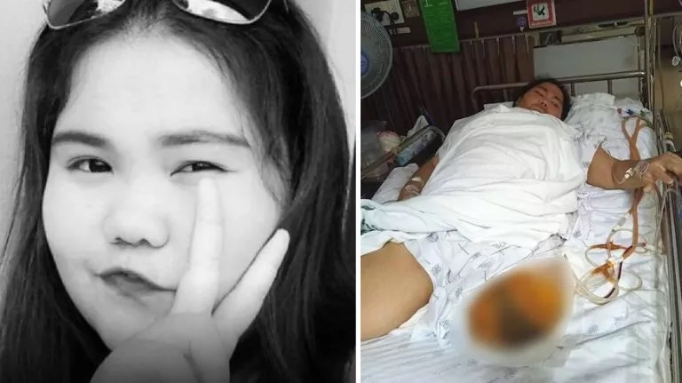 Thai student Ketsiri Kongkaew had to have her leg amputated after Covid Vax