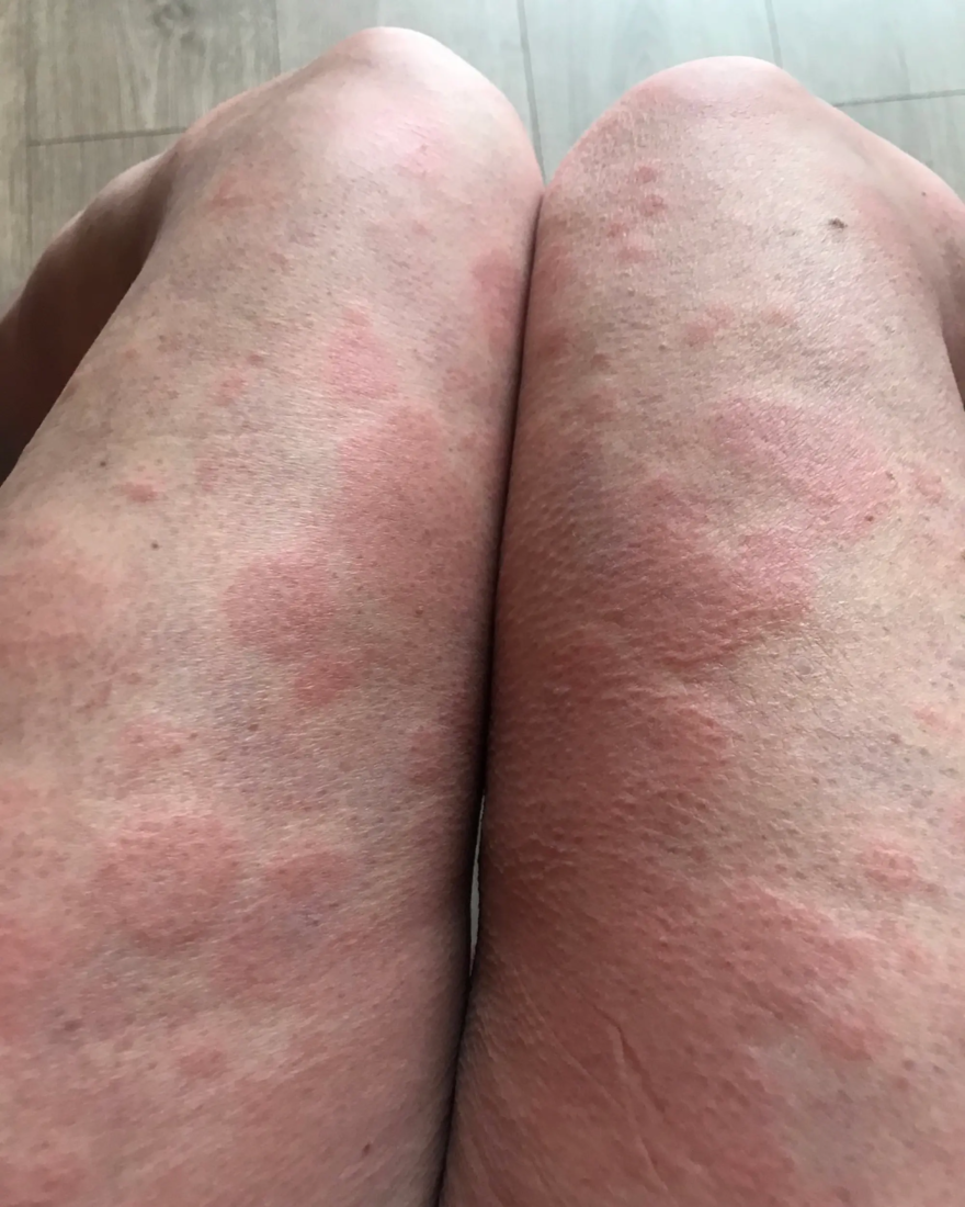 Suzie Forbes’ legs show an extreme rash.Triangle News