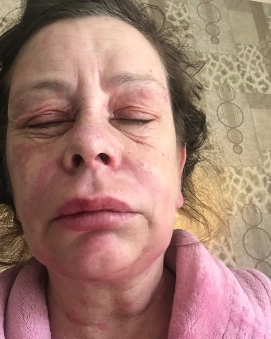 Swelling and a rash can be seen on Suzie Forbes’ faceTriangle News