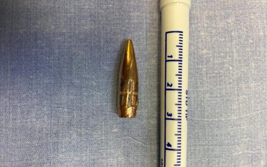 Bullet removed from injured IDF soldier by Hadassah Medical Center spine surgeons using robot-guided minimally invasive surgery, December 2023. (Courtesy of Hadassah)